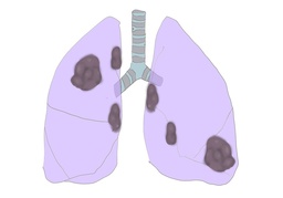 lung cancerのイラスト